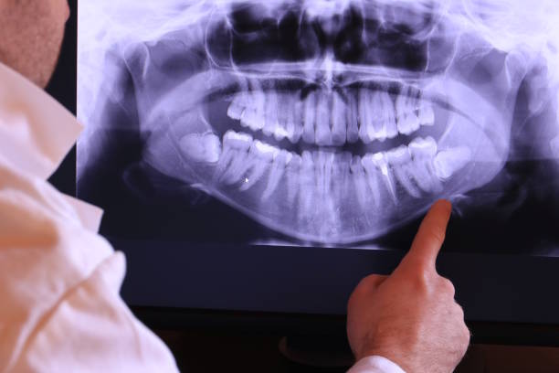 Best Emergency Tooth Extraction in Grafton, ND